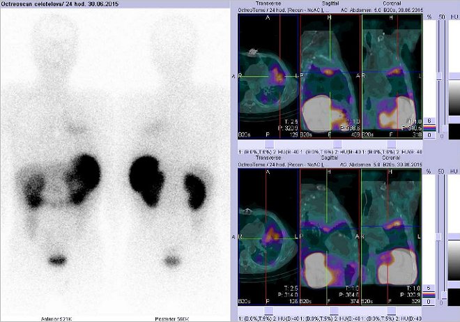 Obr. č. 4: Celotělová scintigrafie a fúze obrazů SPECT a CT – vyšetření hrudníku. Vyšetření 24 hod. po aplikaci radiofarmaka. Vždy nad sebou: vlevo transverzální řezy, uprostřed sagitální řezy, vpravo koronární. Vpravo nahoře i dole zaměřeno na ložisko v levé plíci.