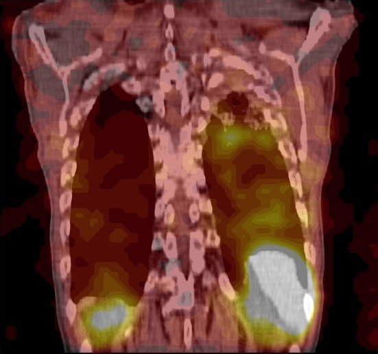 Obr. č. 6: Fúze obrazů SPECT a CT – vyšetření hrudníku. Vyšetření 24 hod. po aplikaci radiofarmaka. Koronární řez.
