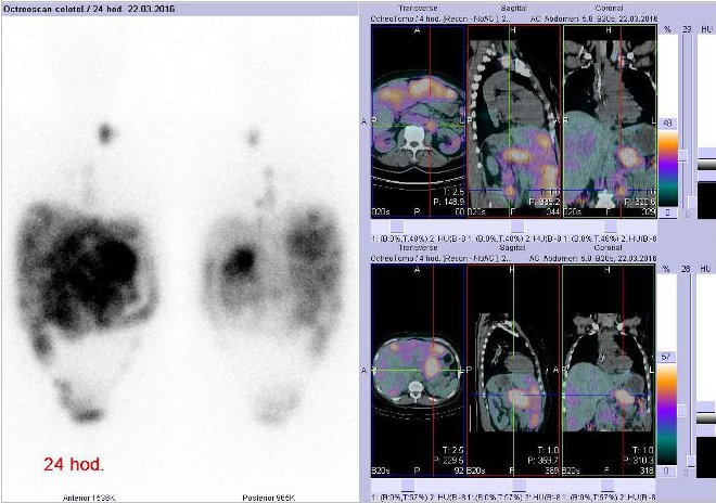 Obr. č. 3: Celotělová scintigrafie v přední a zadní projekci a fúze obrazů SPECT a CT. Zaměřeno na uzlinu v retroperitoneu vlevo paraaortálně a na výrazné ložisko v pankreatu. Vyšetření 24 hod. po aplikaci radioindikátoru.