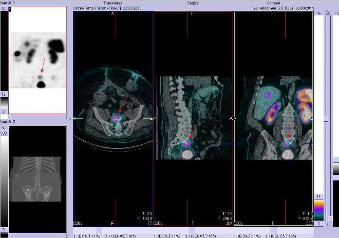 Obr.1: Fúze obrazů SPECT a CT. Zaměřeno na ložisko uložené presakrálně vpravo. Řez transverzální, sagitální a koronární. Vyšetření 4 hod. po aplikaci OctreoScanu.