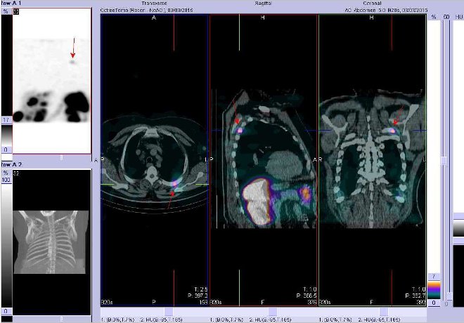 Obr.3: Fúze obrazů SPECT a CT. Zaměřeno na ložisko uložené ve 4. žebru vlevo dorzálně. Řez transverzální, sagitální a koronární. Vyšetření 28 hod. po aplikaci OctreoScanu.