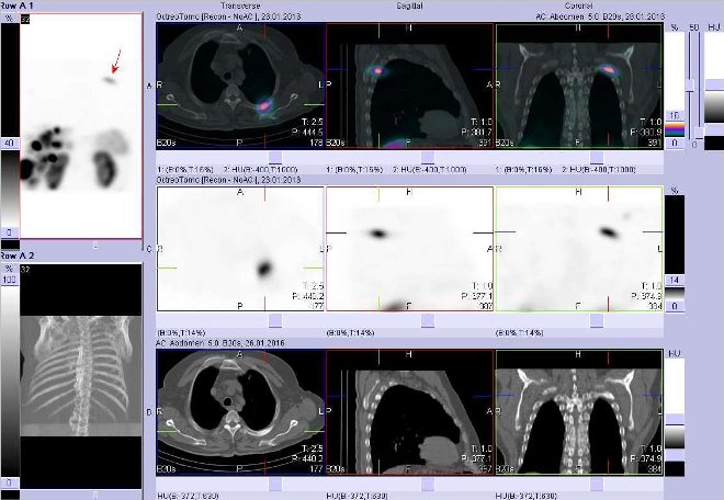 Obr. č. 6: Fúze obrazů SPECT a CT. Zaměřeno na ložisko uložené ve 4. žebru vlevo dorzálně. Nahoře fúze obrazů, uprostřed SPECT, dole CT. Řezy transverzální, sagitální a koronární. Vyšetření 24 hod. po aplikaci OctreoScanu.