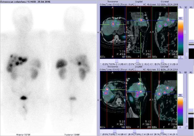 Obr..1: Celotlov scintigrafie vpedn a zadn projekci a fze SPECT/CT bicha a pnve 5 hod. po aplikaci OctreoScanu. Zameno na loiska vjtrech.