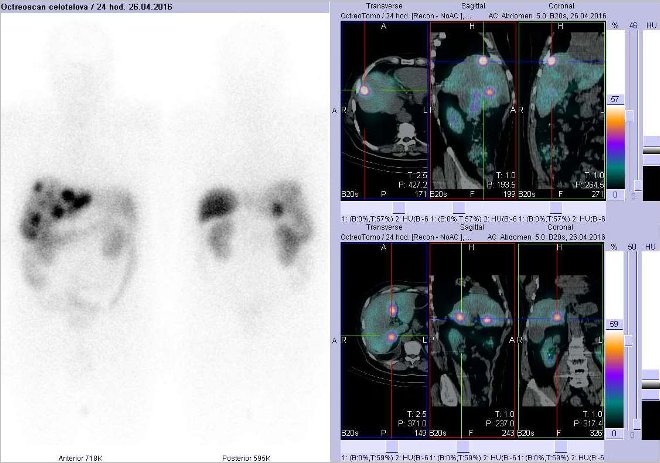 Obr. . 2: Celotlov scintigrafie vpedn a zadn projekci a fze SPECT/CT bicha a pnve 24 hod. po aplikaci OctreoScanu. Zameno na loiska vjtrech.