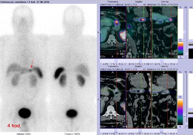 Obr.č.1: Celotělová scintigrafie v přední a zadní projekci a fúze SPECT/CT 4 hod. po aplikaci OctreoScanu. Zaměřeno na ložisko v žaludku.