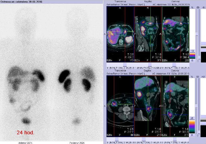 Obr. č. 2: Celotělová scintigrafie v přední a zadní projekci a fúze SPECT/CT 24 hod. po aplikaci OctreoScanu. Zaměřeno na ložisko v žaludku a fyziologickou akumulaci radiofarmaka ve vzestupném tračníku.