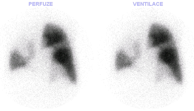 Obr. . 1: AP projekce - perfuze + ventilace.
