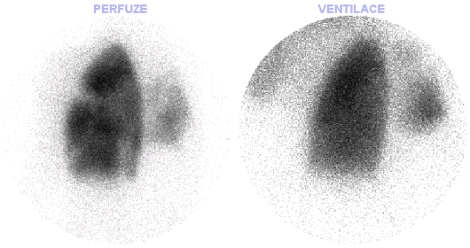Obr. . 3: LPO projekce - perfuze + ventilace.