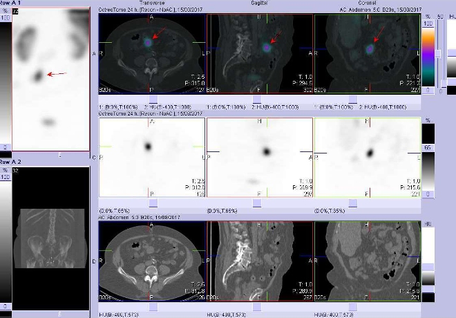 Obr. . 5: Fze SPECT/CT bicha a pnve 24 hod. po aplikaci OctreoScanu. Zameno na loisko vmezenteriu vblzkosti pupku.