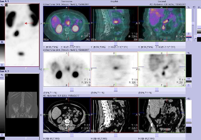 Obr. . 6: Fze SPECT/CT bicha a pnve 24 hod. po aplikaci OctreoScanu. Zameno na mlo aktivn loisko vduodenu.
