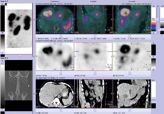 Obr. č. 5: Fúze obrazů SPECT a CT. Vyšetření 4 hod. po aplikaci radiofarmaka. Zaměřeno na ložisko  v levém jaterním laloku.