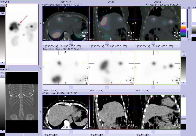 Obr. č. 4: Fúze obrazů SPECT a CT. Vyšetření 5 hod. po aplikaci radioindikátoru. Zaměřeno na ložisko ve ventrální části pravého jaterního laloku.