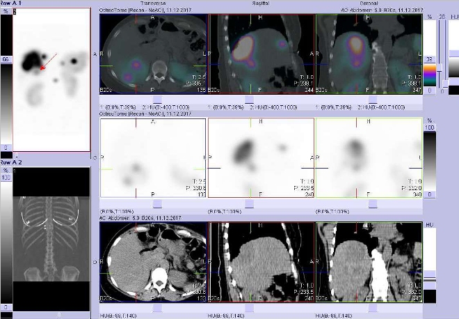 Obr. č. 5: Fúze obrazů SPECT a CT. Vyšetření 5 hod. po aplikaci radioindikátoru. Zaměřeno na ložisko v dorzální části pravého jaterního laloku.