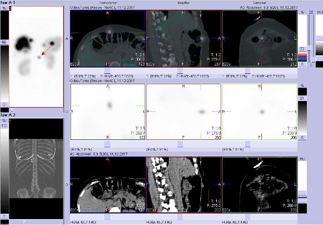 Obr. č. 6: Fúze obrazů SPECT a CT. Vyšetření 5 hod. po aplikaci radioindikátoru. Zaměřeno na ložisko povrchově v břišní stěně vpravo.