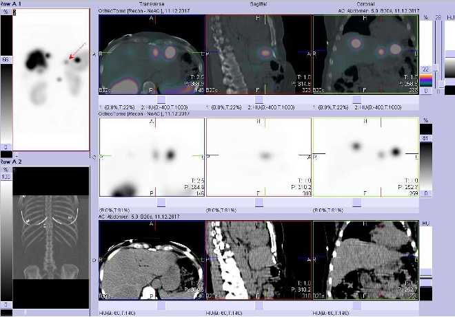Obr. č. 7a: Fúze obrazů SPECT a CT. Vyšetření 5 hod. po aplikaci radioindikátoru. Zaměřeno na ložisko ve ventrální části levého jaterního laloku.