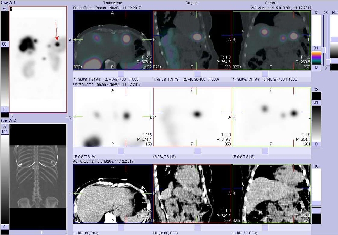 Obr. č. 7b: Fúze obrazů SPECT a CT. Vyšetření 5 hod. po aplikaci radioindikátoru. Zaměřeno na ložisko ve ventrální části levého jaterního laloku.
