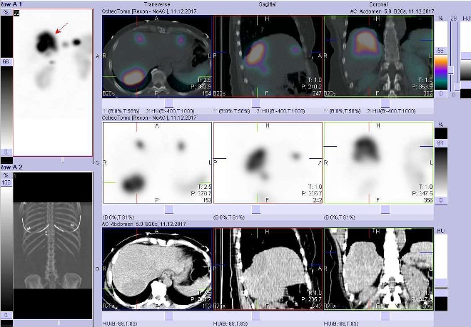 Obr. č. 8: Fúze obrazů SPECT a CT. Vyšetření 5 hod. po aplikaci radioindikátoru. Zaměřeno na velké ložisko v dorzální části pravého jaterního laloku.
