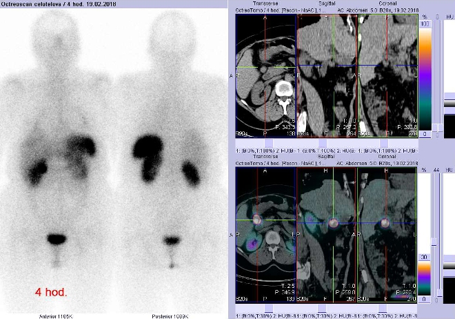 Obr. č. 2: Celotělová scintigrafie v přední a zadní projekci a fúze obrazů SPECT a CT. Vyšetření 4  hod. po aplikaci radioindikátoru. Vpravo zaměřeno na ložisko mezi pankreatem a duodenem.