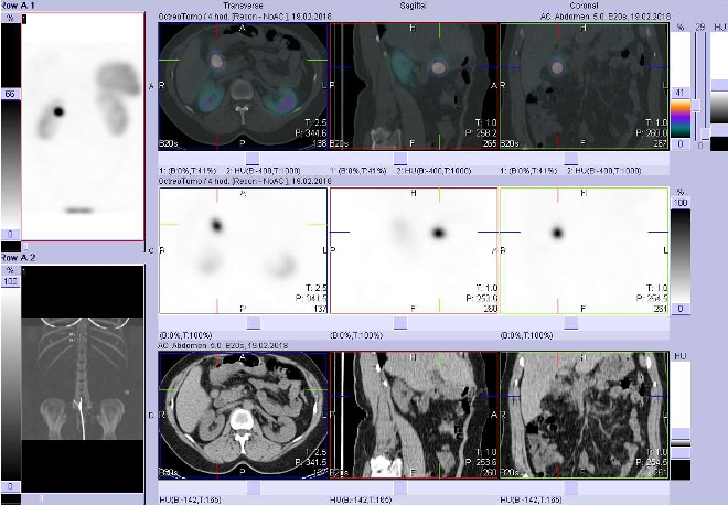 Obr. č. 3: Fúze obrazů SPECT a CT. Vyšetření 4 hod. po aplikaci radioindikátoru. Zaměřeno na ložisko mezi pankreatem a duodenem.