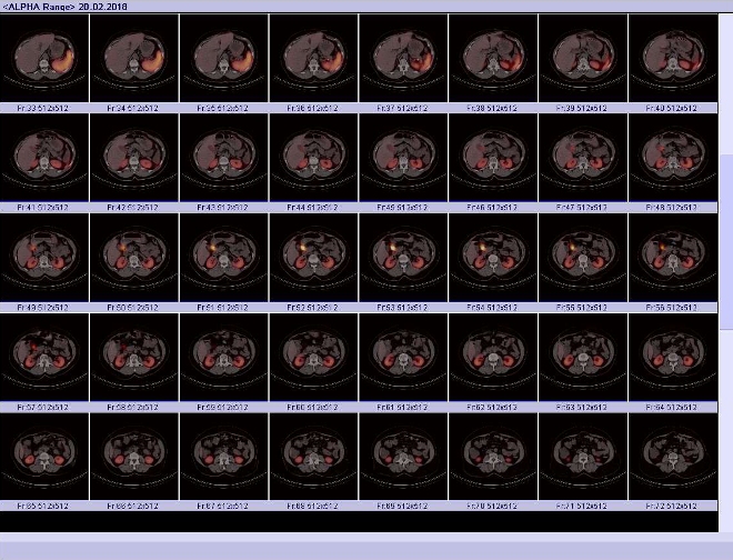 Obr. č. 5: Fúze obrazů SPECT a CT. Vyšetření 24 hod. po aplikaci radioindikátoru. Řez axiální. Patrné ložisko mezi pankreatem a duodenem.