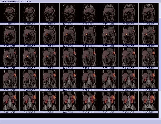Obr. č. 6: Fúze obrazů SPECT a CT. Vyšetření 24 hod. po aplikaci radioindikátoru. Řez koronární. Patrné ložisko mezi pankreatem a duodenem.