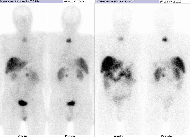 Obr. č. 1: Celotělová scintigrafie v přední a zadní projekci 4 (vlevo) a 24 (vpravo) hod. po aplikaci OctreoScanu.
