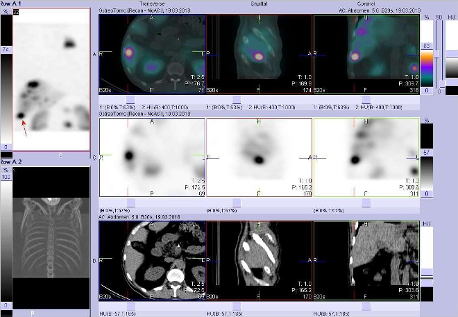 Obr. č. 3: Fúze SPECT/CT 4 hod. po aplikaci OctreoScanu. Zaměřeno na ložisko v laterokaudální části pravého jaterního laloku.