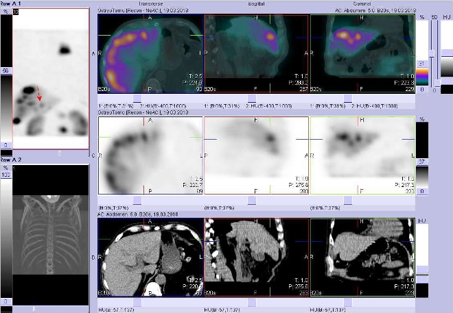 Obr. č. 6: Fúze SPECT/CT 4 hod. po aplikaci OctreoScanu. Zaměřeno na ložisko ve ventrální části jater na rozhraní pravého a levého laloku.