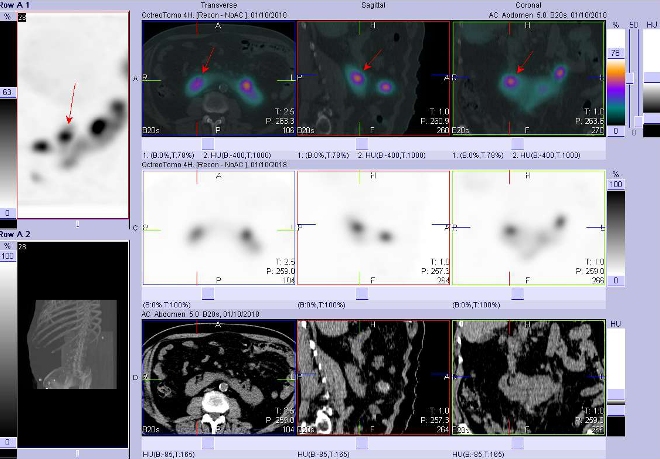 Obr. č. 5: Fúze obrazů SPECT a CT. Vyšetření 4 hod. po aplikaci radioindikátoru. Zaměřeno na ložisko v dutém systému pravé části podkovovité ledviny.