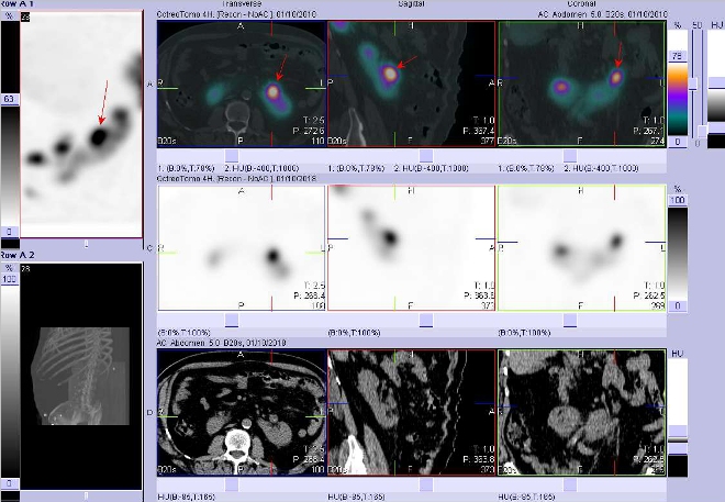 Obr. č. 6: Fúze obrazů SPECT a CT. Vyšetření 4 hod. po aplikaci radioindikátoru. Zaměřeno na ložisko v dutém systému levé části podkovovité ledviny.