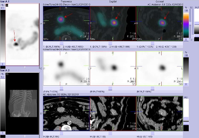 Obr. č. 7: Fúze obrazů SPECT a CT. Vyšetření 24 hod. po aplikaci radioindikátoru. Zaměřeno na ložisko v pravém mezogastriu.