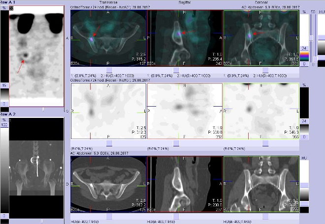 Obr. č. 2: Fúze obrazů SPECT a CT.  Zaměřeno na ložisko v pravé kosti kyčelní. Vyšetření 24 hod. po aplikaci OctreoScanu.