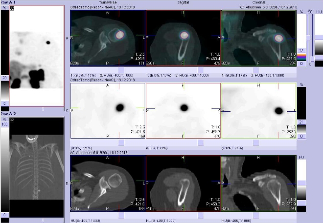 Obr. č. 6: Fúze obrazů SPECT a CT.  Zaměřeno na ložisko v proximální části levého humeru. Vyšetření 24 hod. po aplikaci OctreoScanu.