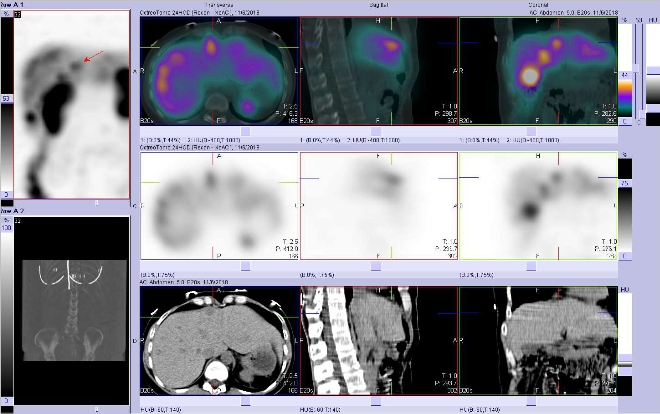 Obr. . 10: Fze SPECT/CT 24 hod. po aplikaci OctreoScanu. Zameno na loisko ve ventrln sti pravho jaternho laloku.