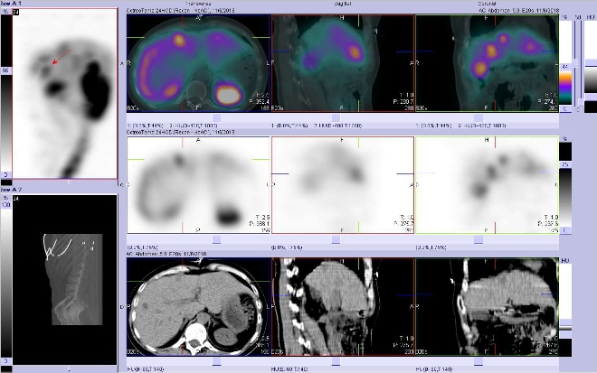 Obr. . 11: Fze SPECT/CT 24 hod. po aplikaci OctreoScanu. Zameno na loisko ve ventrln sti pravho jaternho laloku.