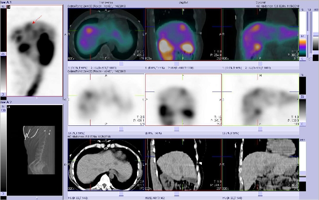 Obr. . 12: Fze SPECT/CT 24 hod. po aplikaci OctreoScanu. Zameno na loisko ve ventrokraniln sti pravho jaternho laloku.