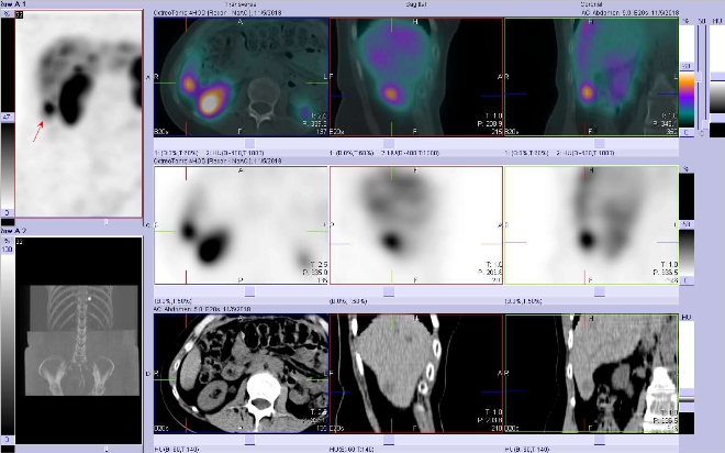 Obr.3: Fze SPECT/CT 4 hod. po aplikaci OctreoScanu. Zameno na loisko vdistln sti pravho jaternho laloku.