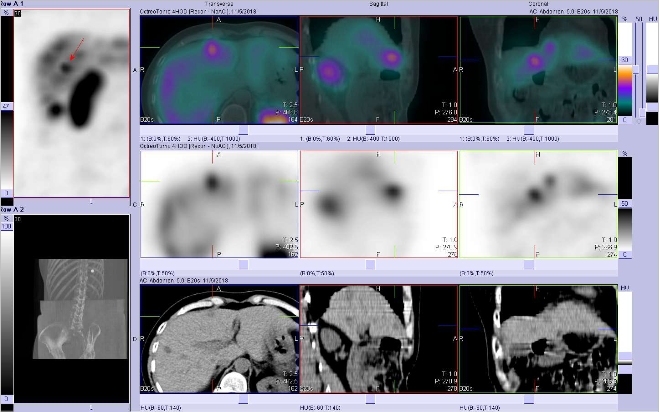 Obr. . 4: Fze SPECT/CT 4 hod. po aplikaci OctreoScanu. Zameno na loisko ve ventrln sti pravho jaternho laloku.