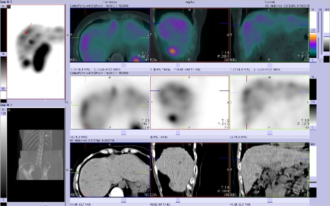 Obr. . 5: Fze SPECT/CT 4 hod. po aplikaci OctreoScanu. Zameno na loisko v laterln sti pravho jaternho laloku.
