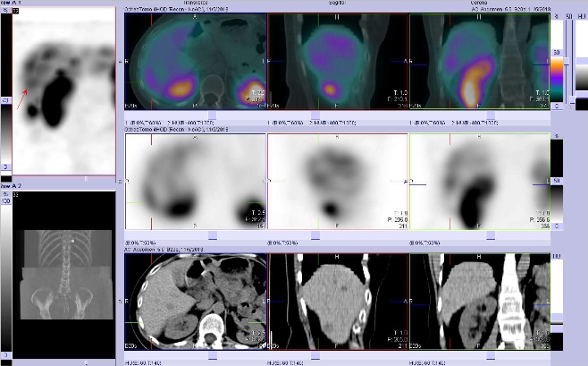 Obr. . 6: Fze SPECT/CT 4 hod. po aplikaci OctreoScanu. Zameno na loisko v laterln sti pravho jaternho laloku.