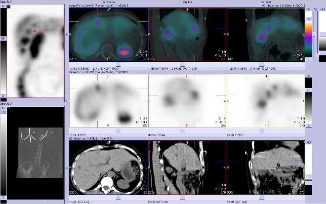 Obr. . 8: Fze SPECT/CT 24 hod. po aplikaci OctreoScanu. Zameno na loisko ve ventrln sti pravho jaternho laloku.