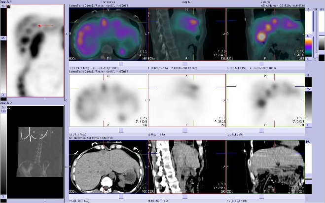 Obr. . 9: Fze SPECT/CT 24 hod. po aplikaci OctreoScanu. Zameno na loisko ve ventrln sti pravho jaternho laloku.