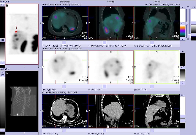 Obr. č. 2: Fúze SPECT/CT hrudníku a proximální části břicha 4 hod. po aplikaci OctreoScanu. Zaměřeno na ložisko v pravém jaterním laloku.