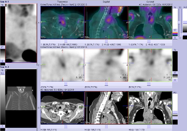 Obr. č. 2: Fúze SPECT/CT – zaměřeno na ložisko ve zvětšeném levém laloku štítné žlázy. Vyšetření 4 hod. po aplikaci radioindikátoru.