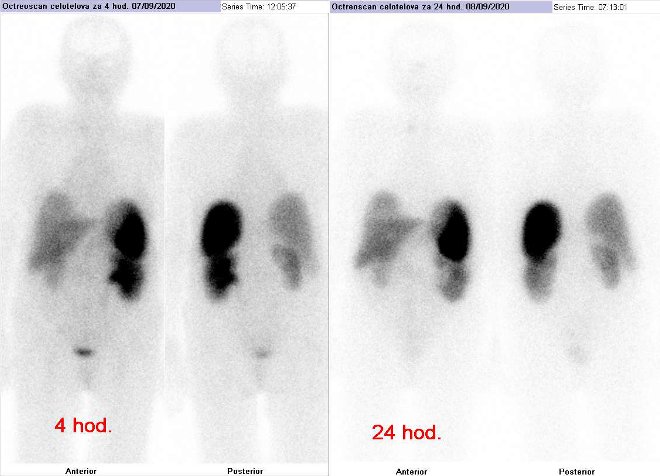 Obr.1: Celotělová scintigrafie v přední a zadní projekci. Vyšetření 4 hod. (vlevo) a 24 hod. (vpravo) po aplikaci radioindikátoru.