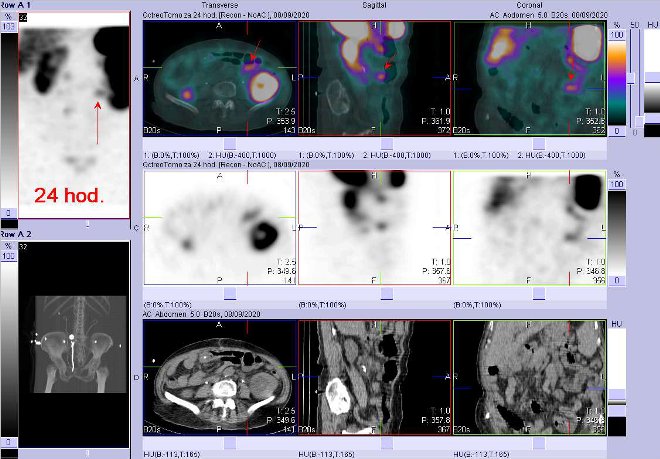 Obr. č. 4: Fúze obrazů SPECT a CT – vyšetření 24 hod. po aplikaci radiofarmaka. Zaměřeno na střevo.
