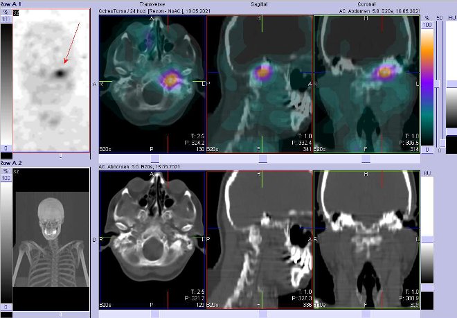 Obr. č. 4: Fúze obrazů SPECT a CT – vyšetření 24 hod. po aplikaci radiofarmaka. Zaměřeno na ložisko v lebce.