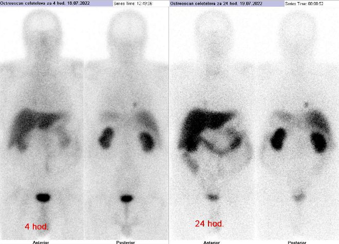 Obr.č.1: Celotělová scintigrafie v přední a zadní projekci 4 (vlevo) a 24 hod. (vpravo) po aplikaci OctreoScanu.