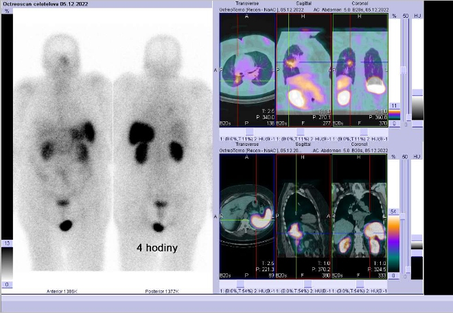 Obr..1: Celotlov scintigrafie v pedn a zadn projekci a fze SPECT/CT 4 hod. po aplikaci OctreoScanu. Zameno na loisko v prav plci.