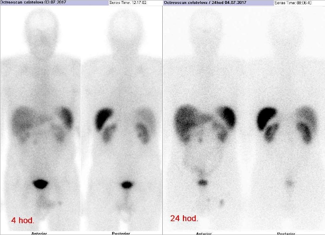 Obr. . 1: Celotlov scintigrafie v pedn a zadn projekci. Vyeten za 4 a 24 hod. po aplikaci radioindiktoru.